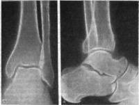 Современное состояние проблемы лечения переломов таранной кости